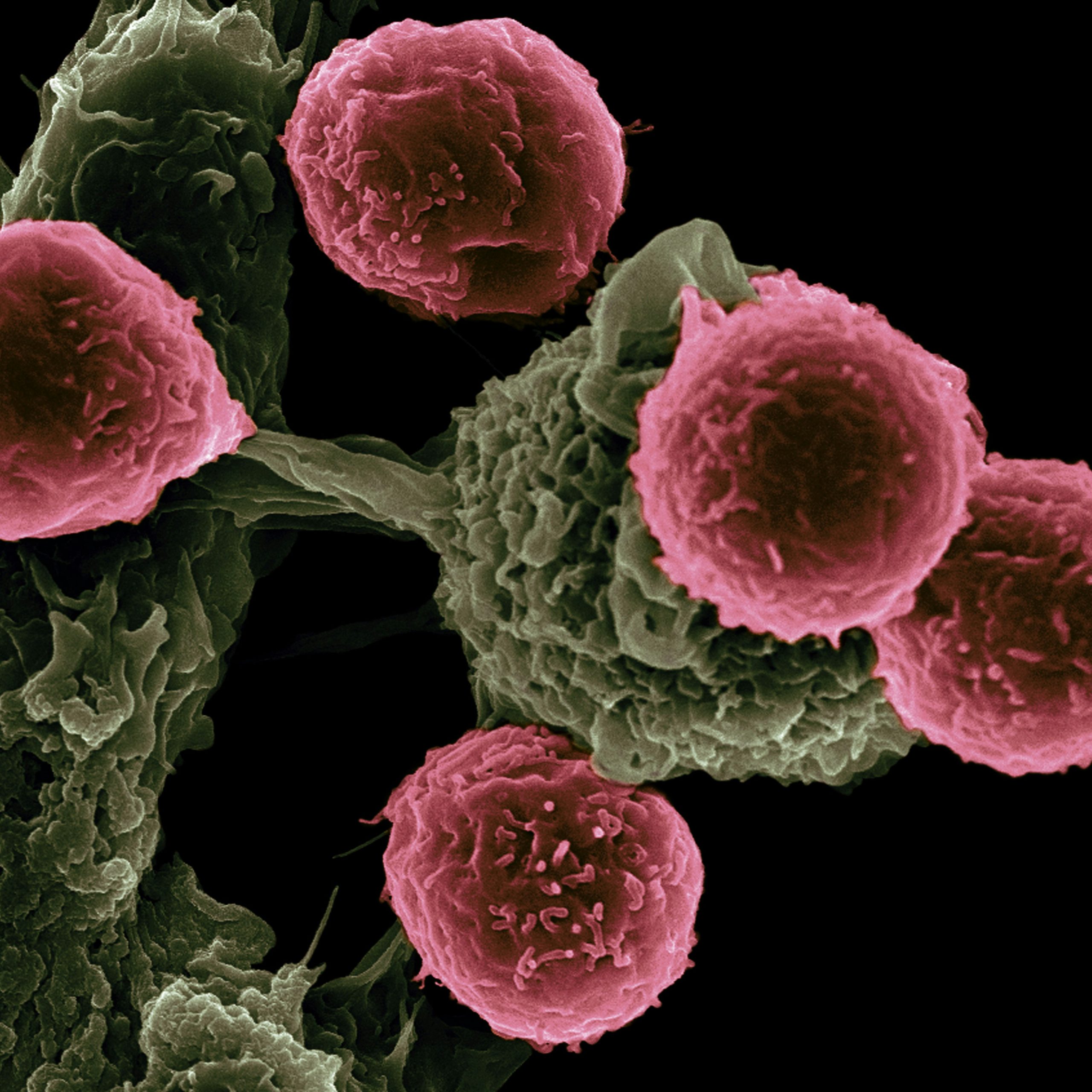 Cancerceller – CBD olja och cancer Mikroskopisk vy av cancerceller – artikel om CBD olja och cancer